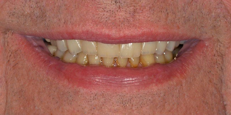 smile-gallery-4-after